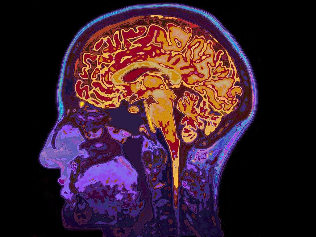 Eventual Brain Damage Observed to go Beyond Motor Neuron Death In ALS