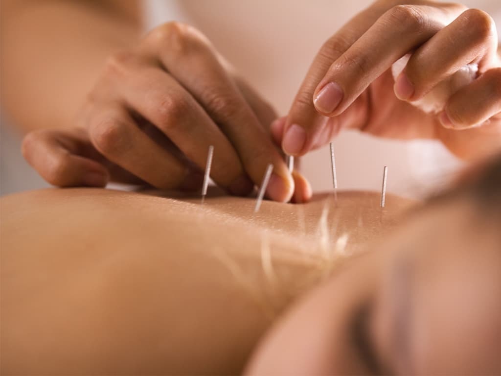 Acupuncture being performed on ALS patient