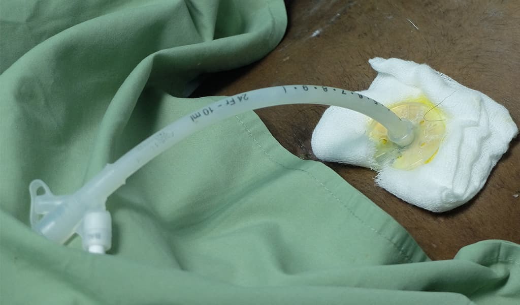 Percutaneous Gastrostomy Tube