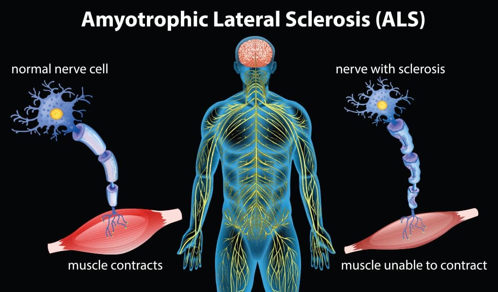 Graphic showing how ALS affects nerve cells