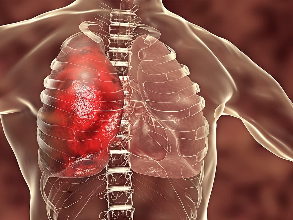 3D graphic depicting pneumonia