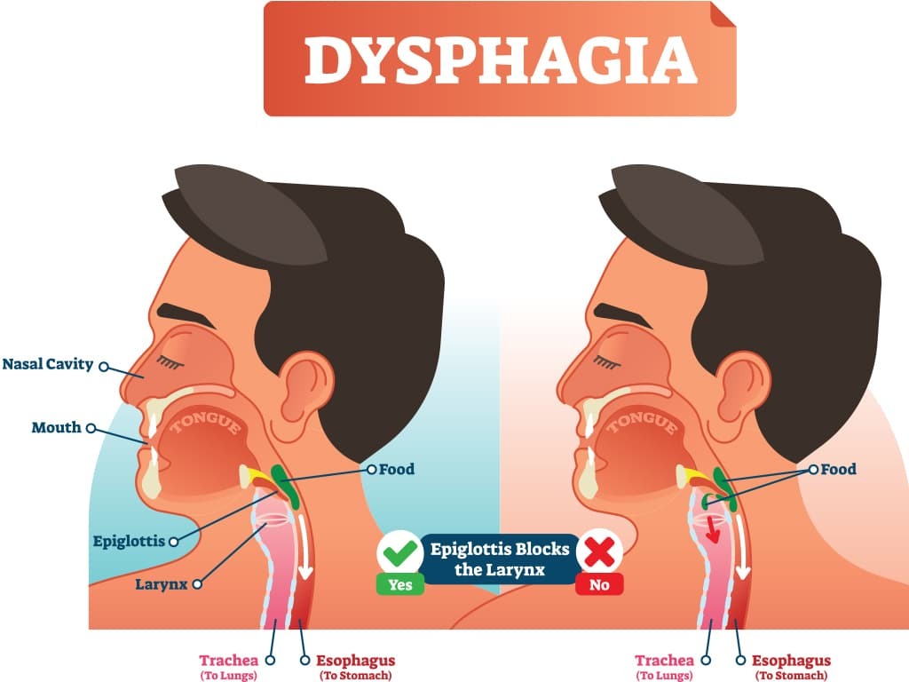 Dysphagia