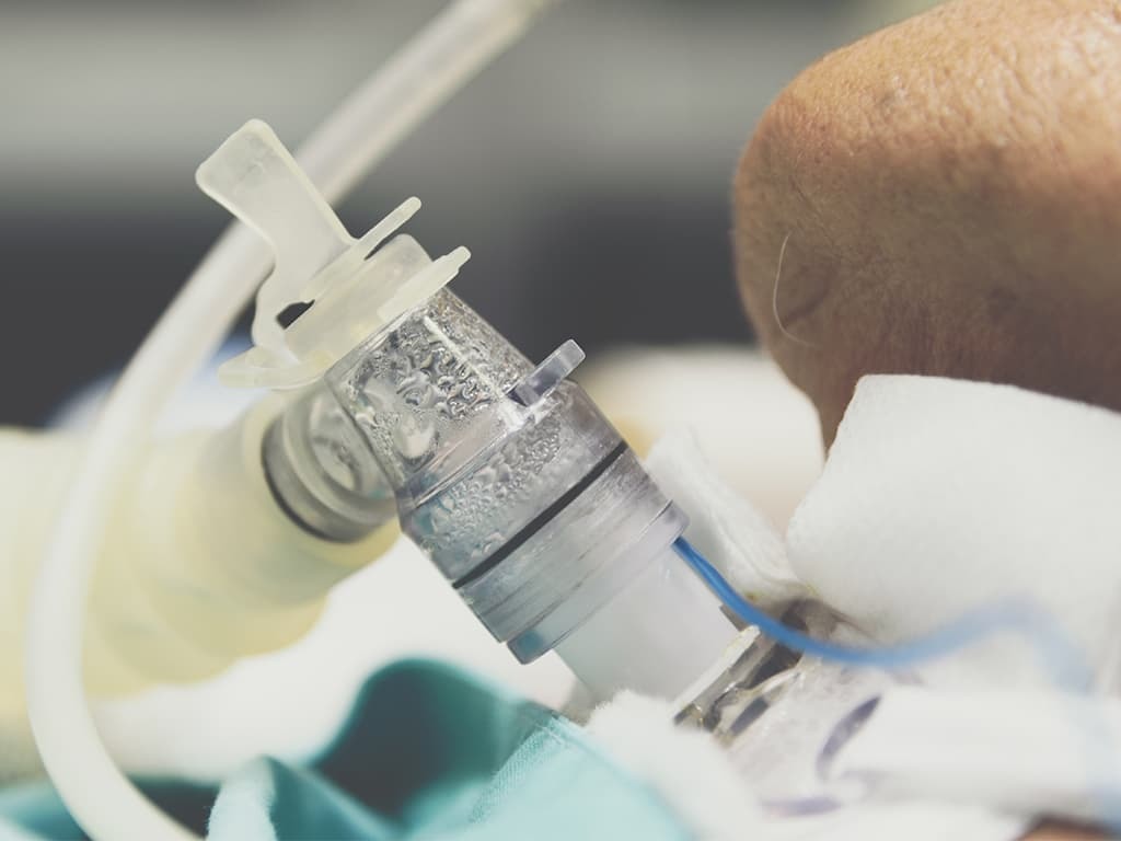 ALS patient with tracheostomy tube