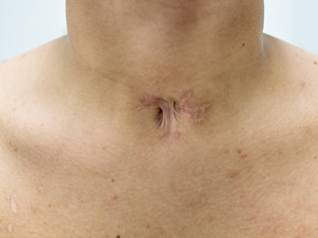 Tracheostomy scar