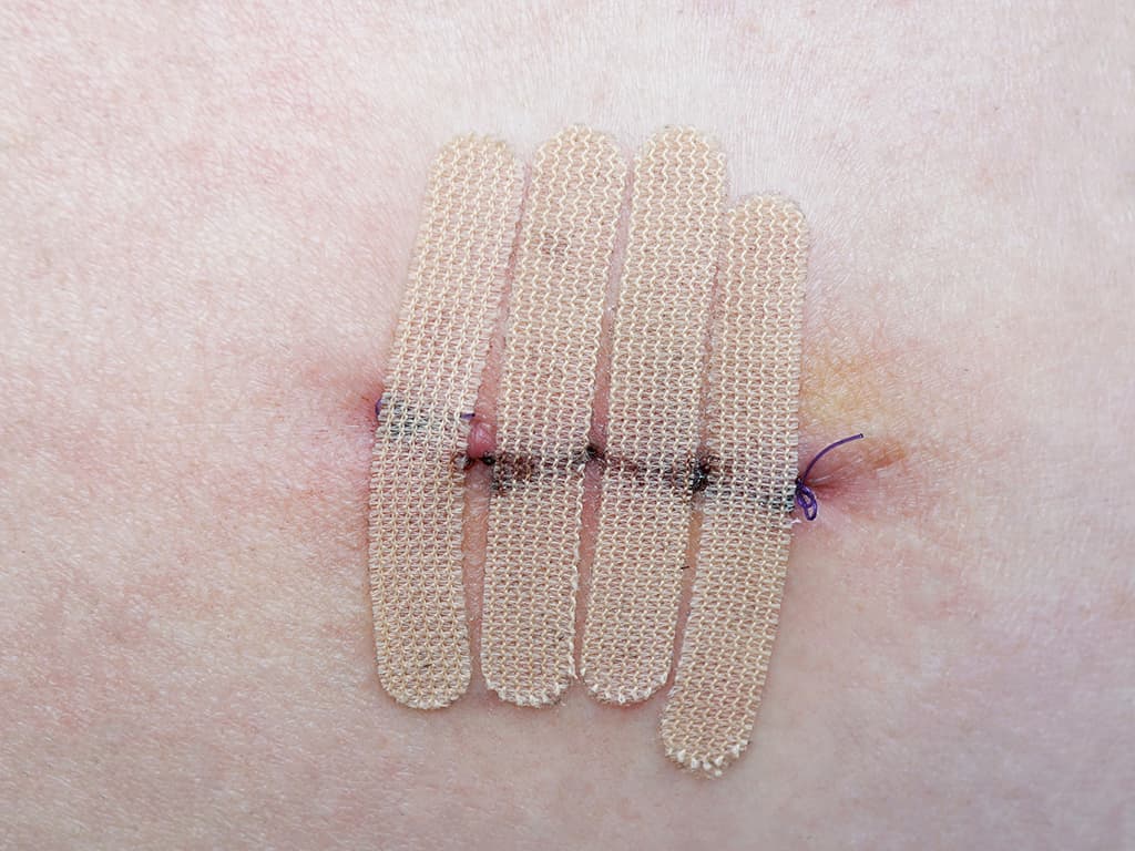 ALS muscle biopsy incision wound
