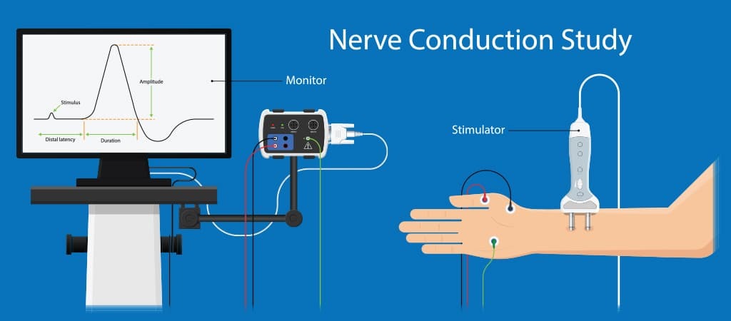 Nerve Conduction Study (NCS)